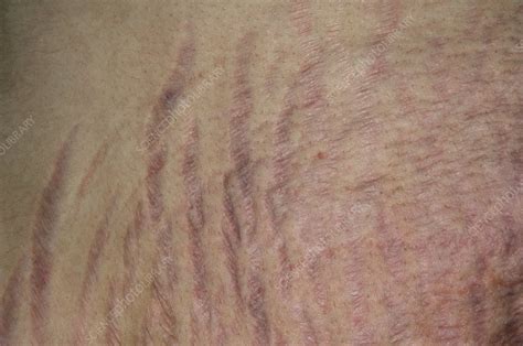 Stretch Marks On The Abdomen Stock Image C0029607 Science Photo