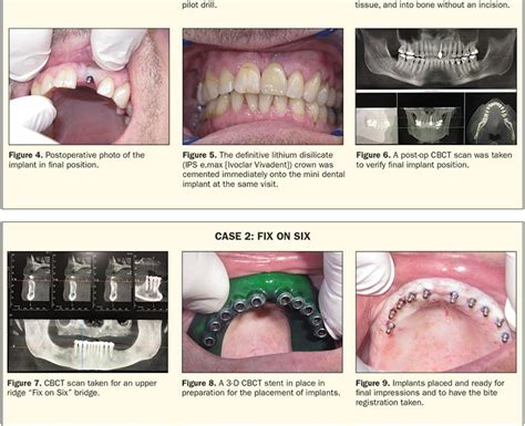 Minimally Invasive Mini Dental Implants Dentistry Today