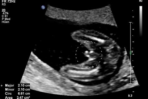 18 Weeks Pregnant Second Trimester Ultrasound Gallery