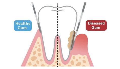 Tips On Periodontal Probing