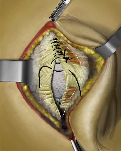 Umbilical Hernia Repair Step 5 By Priapism4art On Deviantart