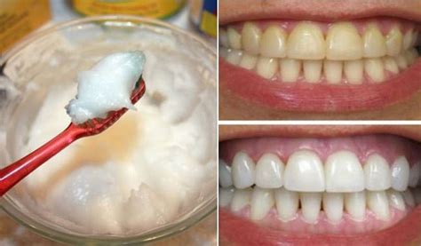 How To Whiten Teeth Fast