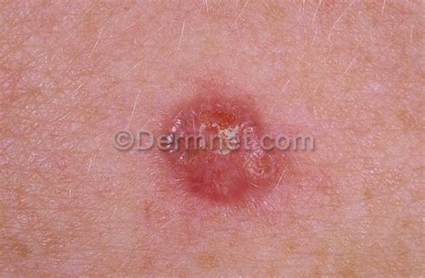 Pictures Of Keratosis Dorothee Padraig South West Skin Health Care