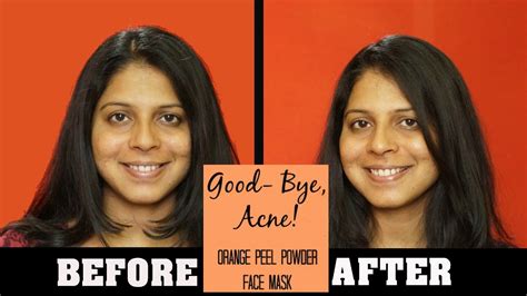 Get Rid Of Acne Orange Peel Powder Face Mask Diy Day 4 Clear Skin