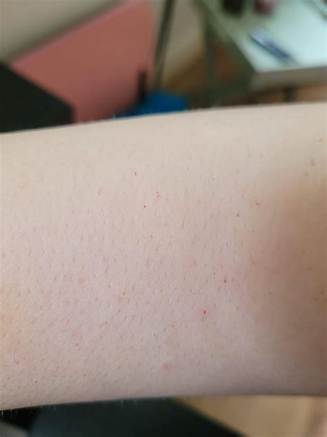 What Are These Weird Specks Of Blood On My Arms Raskdocs