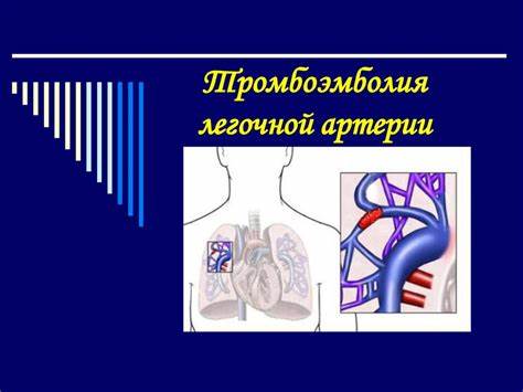 Тромбоэмболия легочной артерии - презентация онлайн Картинка - Тромбоэмболия легочной артерии - презентация онлайн