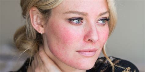 Can Alcohol Affect Rosacea