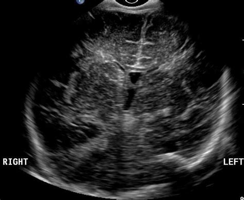 Neonatal Head Ultrasound