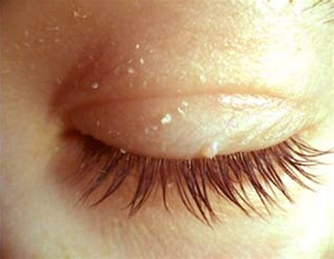 Eczema On Eyelid Treatment Pictures Photos