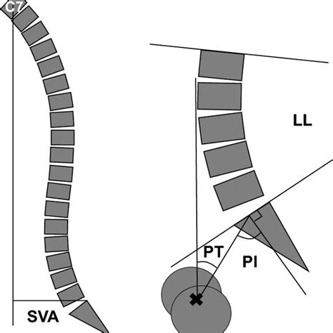 The Spinal Sagittal Alignment Measurements C7 Cervical 7 Sva Sagittal