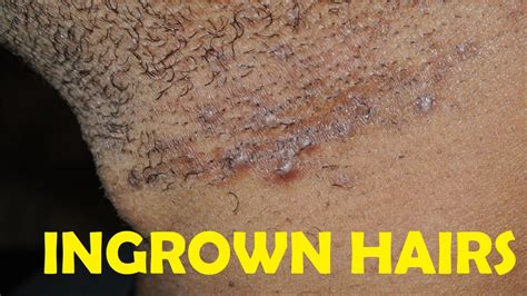 How To Get Rid Of Ingrown Hair Bumps Under Chin Fast Youtube