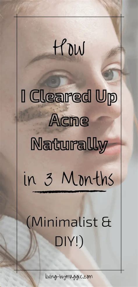 How To Clear Up Your Acne Naturally In 3 Months Living By Maggie