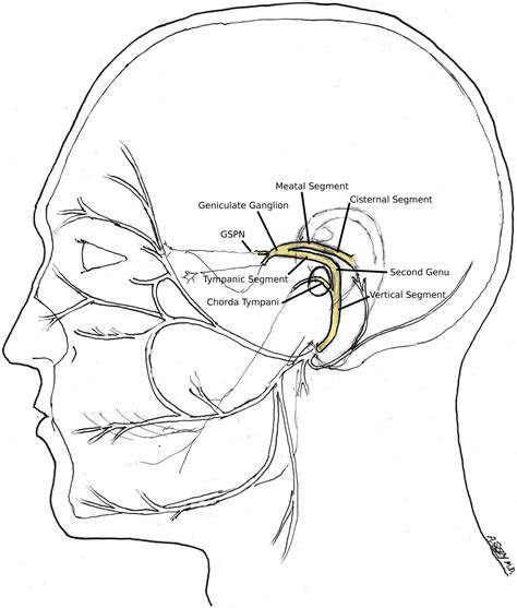 Temporal Bone Fracture Requiring Facial Nerve Decompression Or Repair