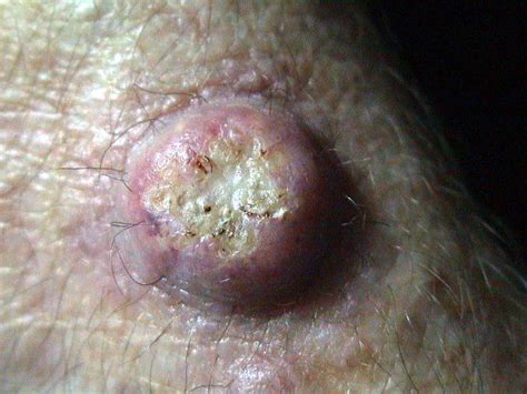 Malignant Lesions Keratoacanthoma Picture Hellenic Dermatological