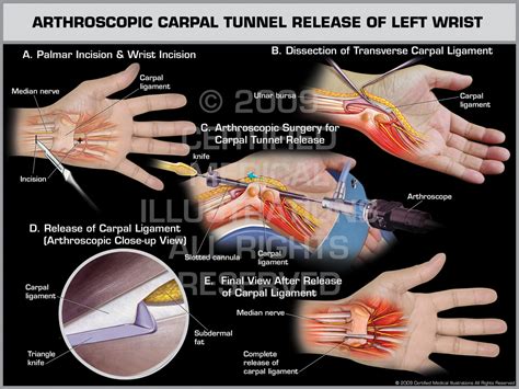 Carpal Tunnel Release Surgery Doctorvisit
