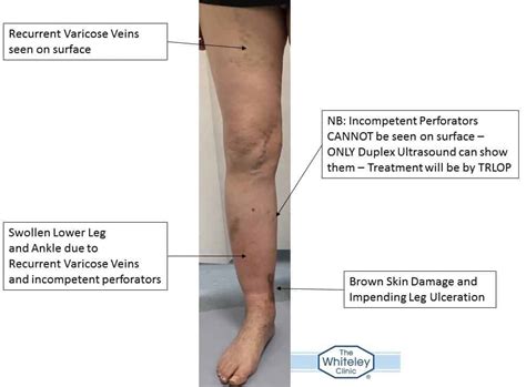 Impending Leg Ulcer From Varicose Veins The Whiteley Clinic