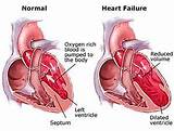 Images of Treatment Of Congestive Heart Failure Includes