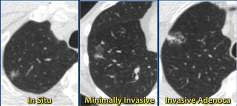 The Radiology Assistant Fleischner 2017 Guideline For Pulmonary Nodules