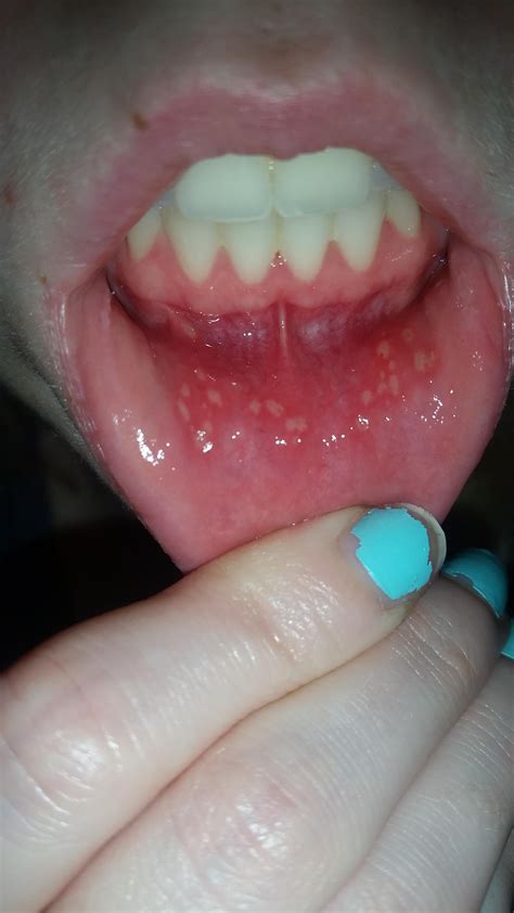 Is It Normal To Get This Many Canker Sores Over Night Askdocs