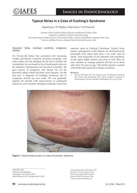 Pdf Typical Striae In A Case Of Cushings Syndrome