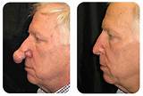 Photos of Laser Treatment For Moles On Face Side Effects