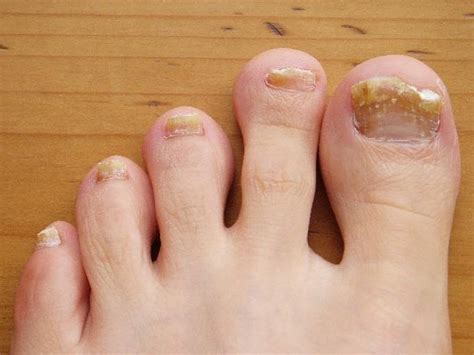 How To Get Rid Of Bad Toenail Fungus Infection Naturally Urban Naturale