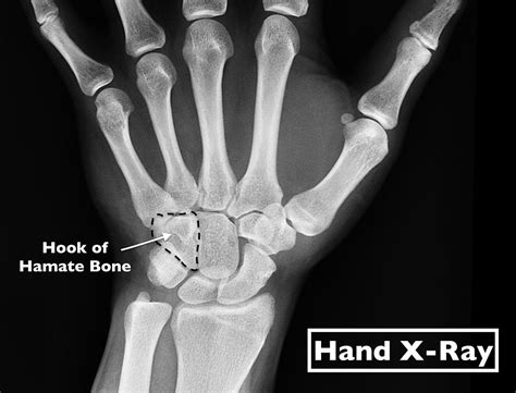 Hamate Fracture In Athletes Can Be Complex