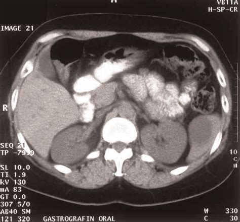 Ct Scan 1997 A 6 Cm Splenic Cyst Is Evident At The Lower Pole Of The