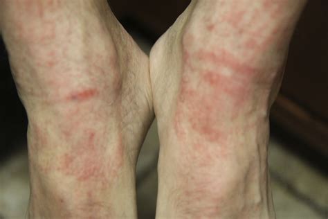 I Have Developed A Rash On The Top Of My Feet And Ankles That