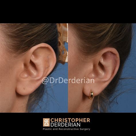 Reduction Otoplasty — Dr Derderian — Plastic And Reconstructive Surgery