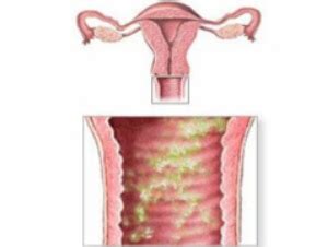 Vaginosis Bacterial Infogen