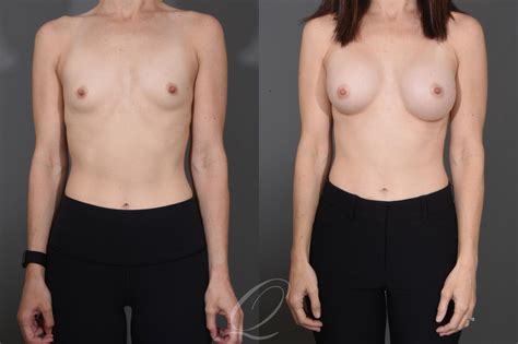 Breast Augmentation Before After Photos Patient 1484 Serving
