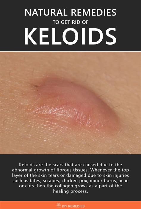 Home Remedies For Keloids The Best Natural Remedies That Are Widely