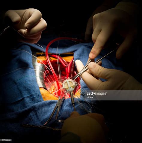 Heart Surgery Aortic Valve Replacement Stock Photo Getty Images