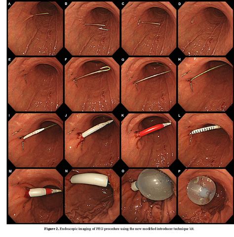 Figure 2 From Percutaneous Endoscopic Gastrostomy Peg Using The