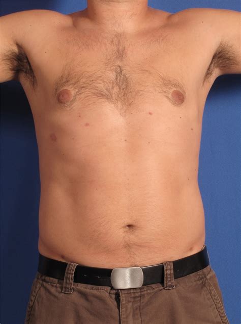 Liposuction Before And After Photos By Stanley Castor Md Tampa Fl