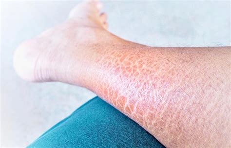 Ichthyosis Vulgaris Causes Symptoms And Treatment Live Heathly Life