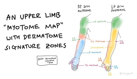 Myotome Map To Remember Muscle Roots Dermatome Signature Zones Medicine