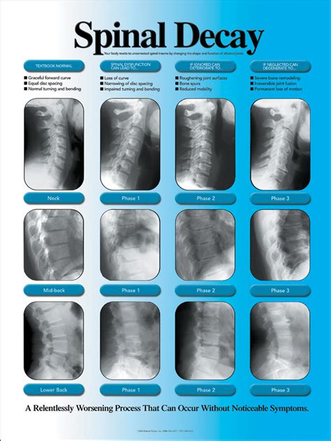 Subluxation Degeneration Chart Chiropractic X Ray Chart