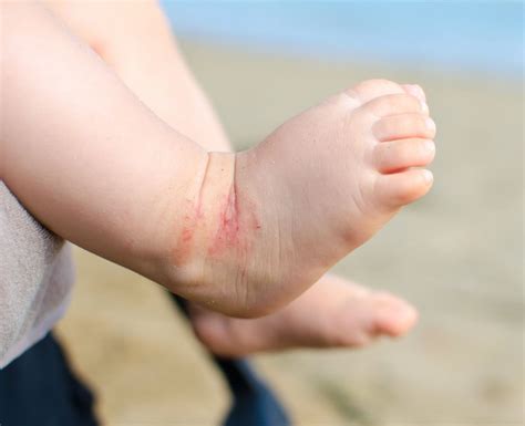 5 Common Childhood Rashes And How To Treat Them