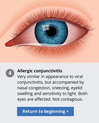 Most cases are not serious and will clear up on their own without. Allergic Pink Eye - TE Koza Optom