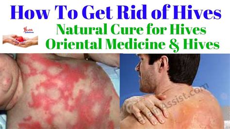 How To Get Rid Of Hives Natural Cure For Hives Oriental Medicine