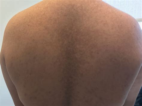 Hyperpigmented Scaly Plaque On Midline Of Back Clinical Advisor