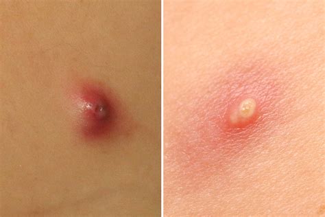 The Difference Between A Pimple And A Boil The Healthy