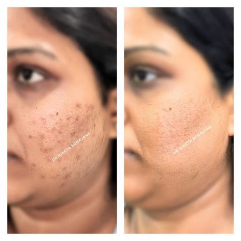 Acne Treatment In Mumbai Cost Best Dermatologist Cystic Acne Specialist