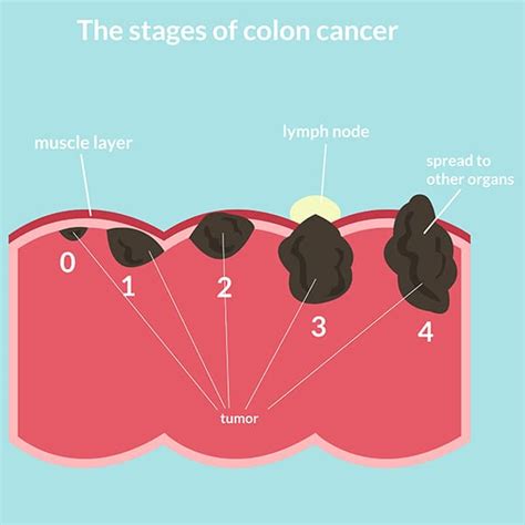 In this article, learn about the signs and symptoms, stages, and treatments, including stage 3: Colon Cancer Is Not Just In Old People! Here's What ...
