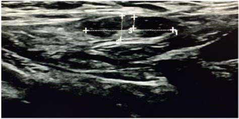 Ultrasound Image Of Left Breast Lesion Download Scientific Diagram