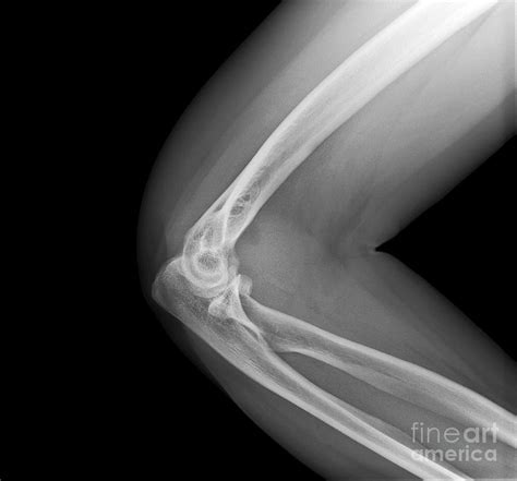 Broken Elbow X Ray Photograph By Science Photo Library Pixels