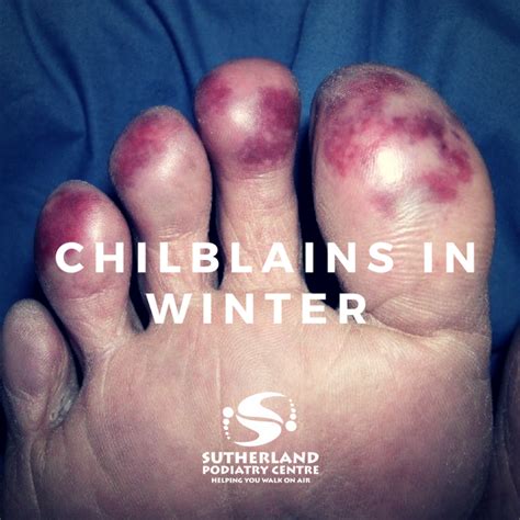 Chilblains In Winter Sutherland Podiatry