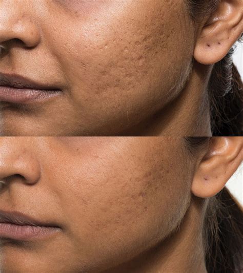 Bellafill Acne Scar Before And After Indian Woman Lookyoungernews